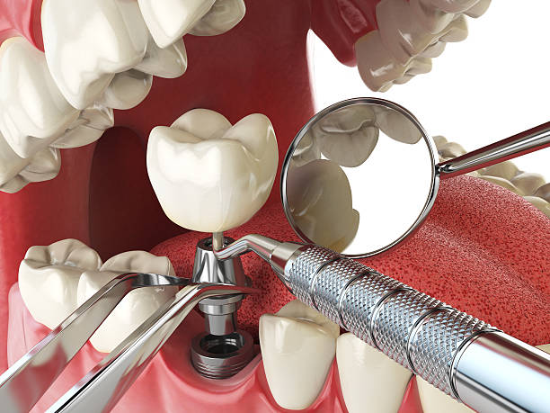 Trusted IN Emergency Dental Service Experts