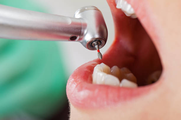 Best Lost Filling or Crown Replacement in Brookville, IN